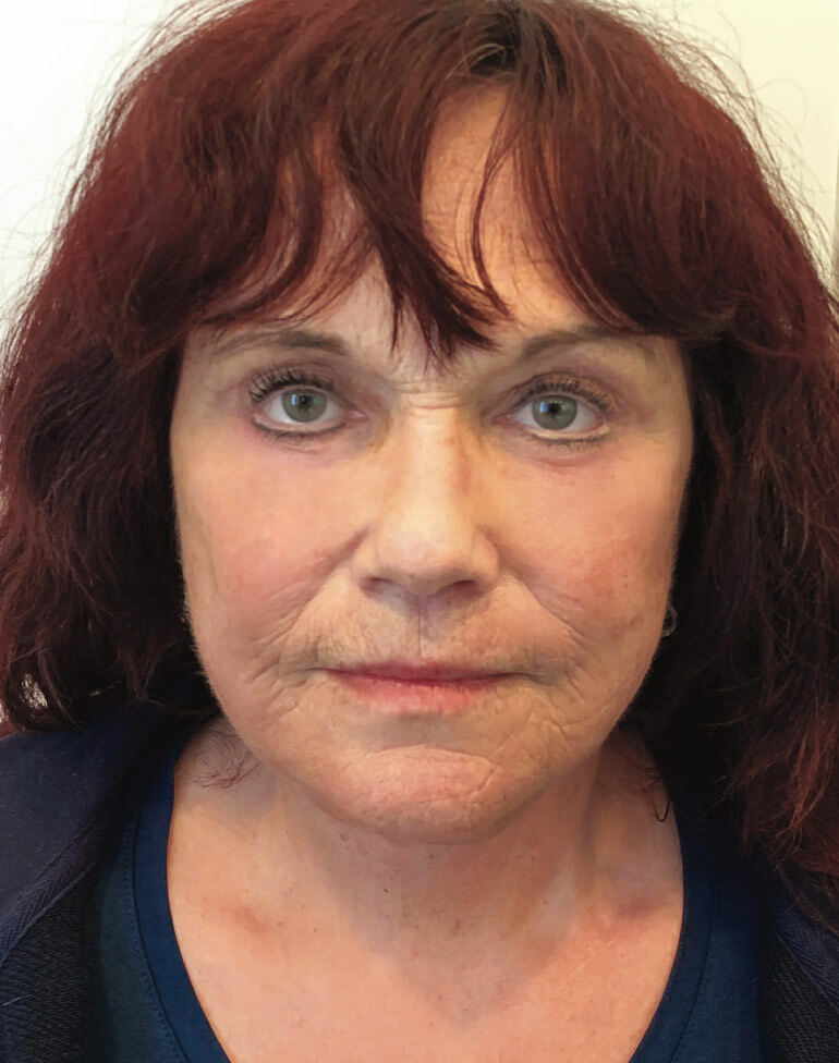 "Schönheits-OP Vorher-Nachher Bilder":  Zeichnen lernen mit dem "Vorher-Nachher" Effekt