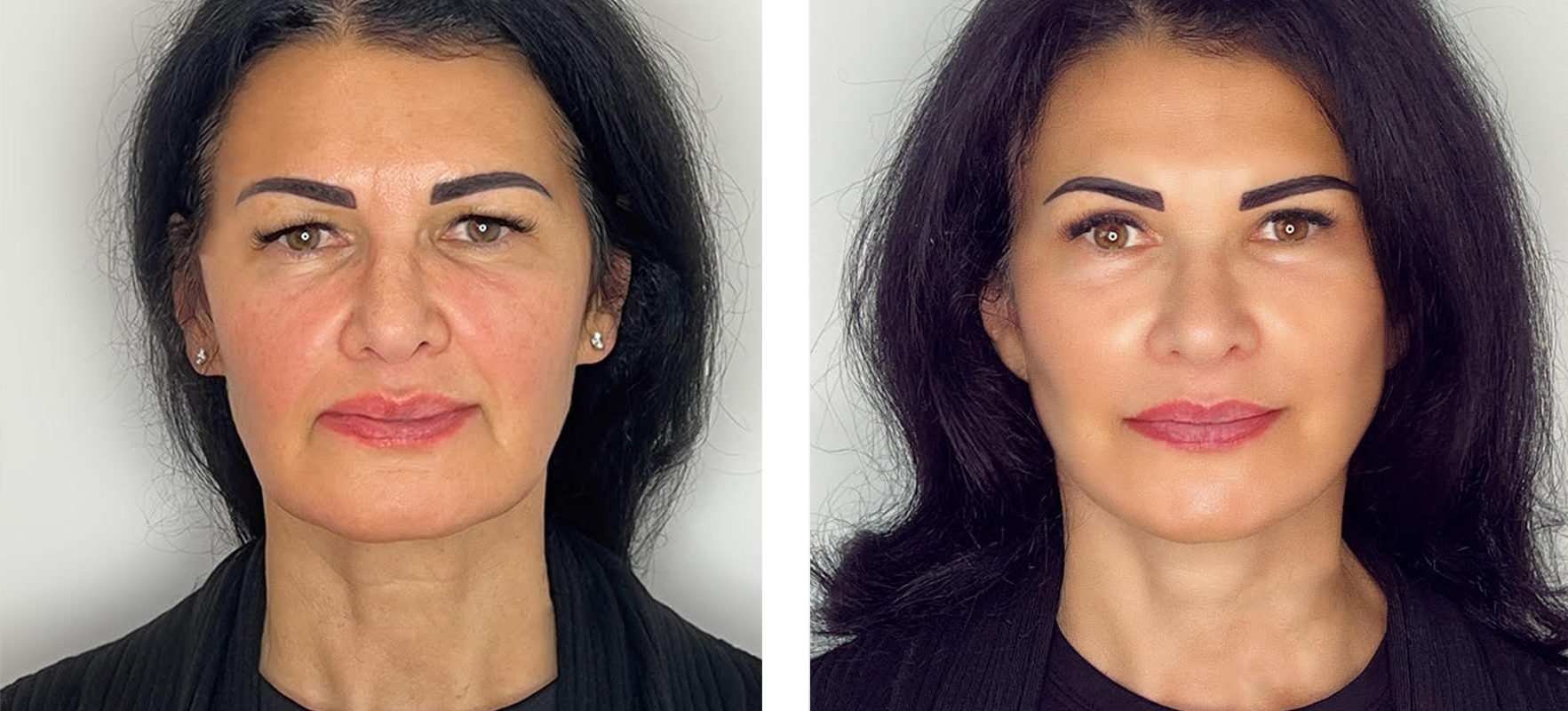 Extended Deep Plane Facelift
