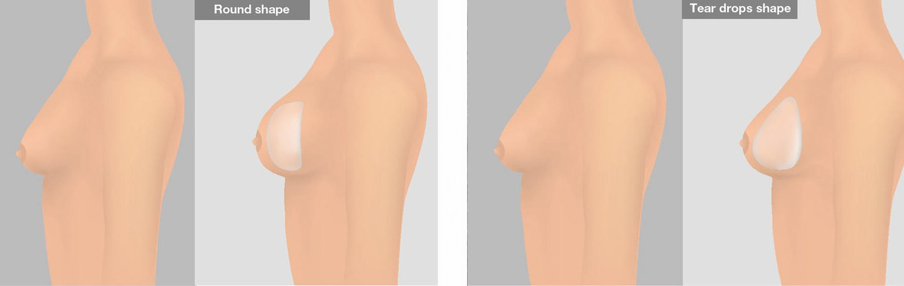Brust Implantat